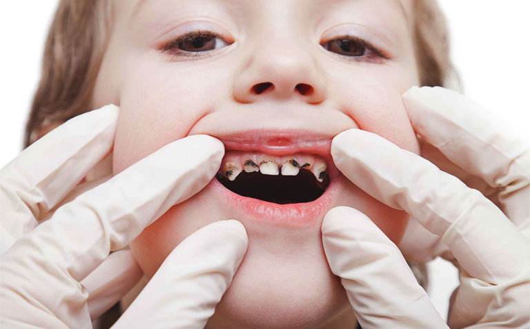 Bệnh sâu răng phổ biến ở trẻ nhỏ