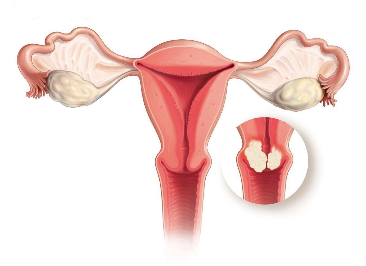 Các cách chẩn đoán ung thư cổ tử cung